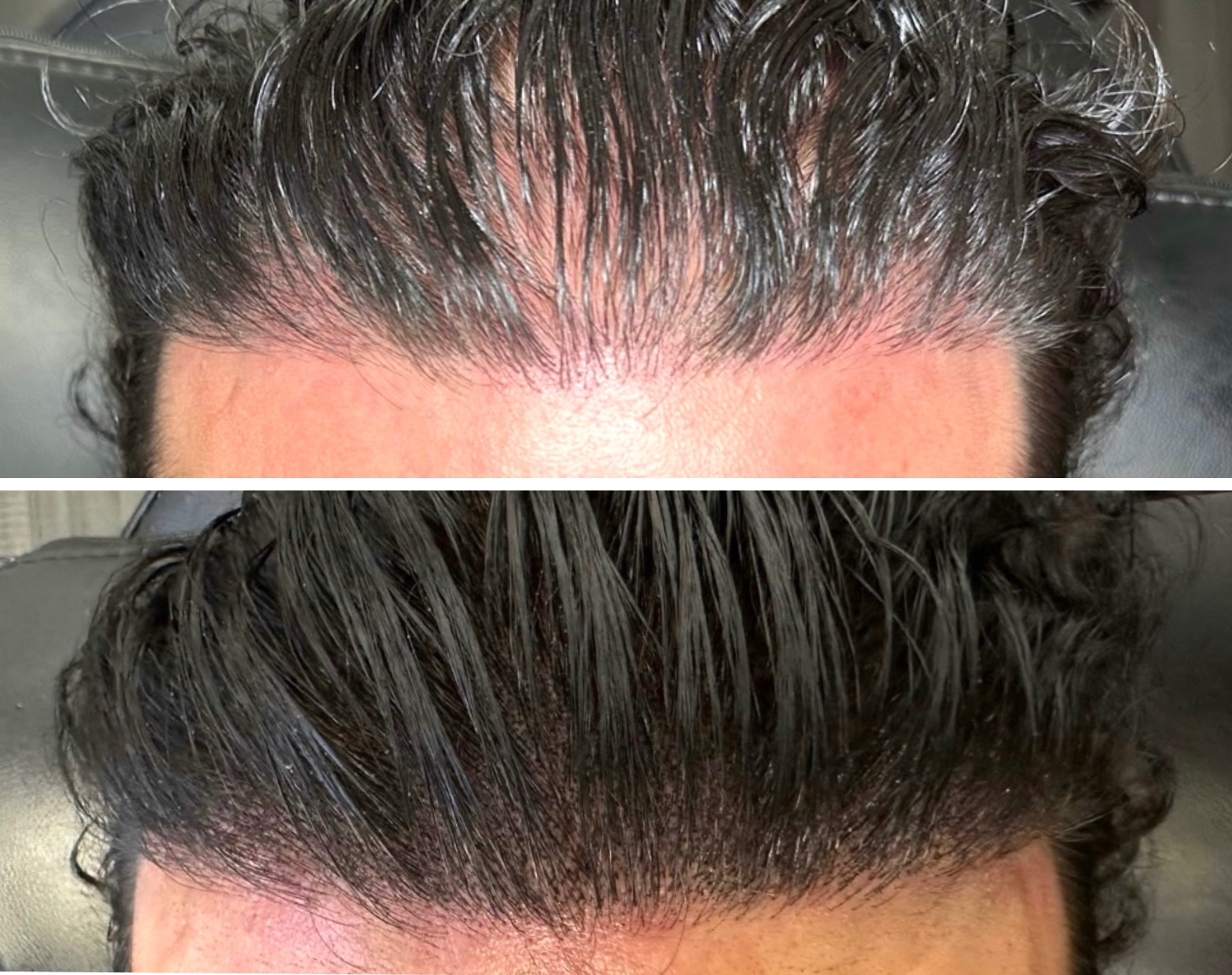 Hair Transplants & Density