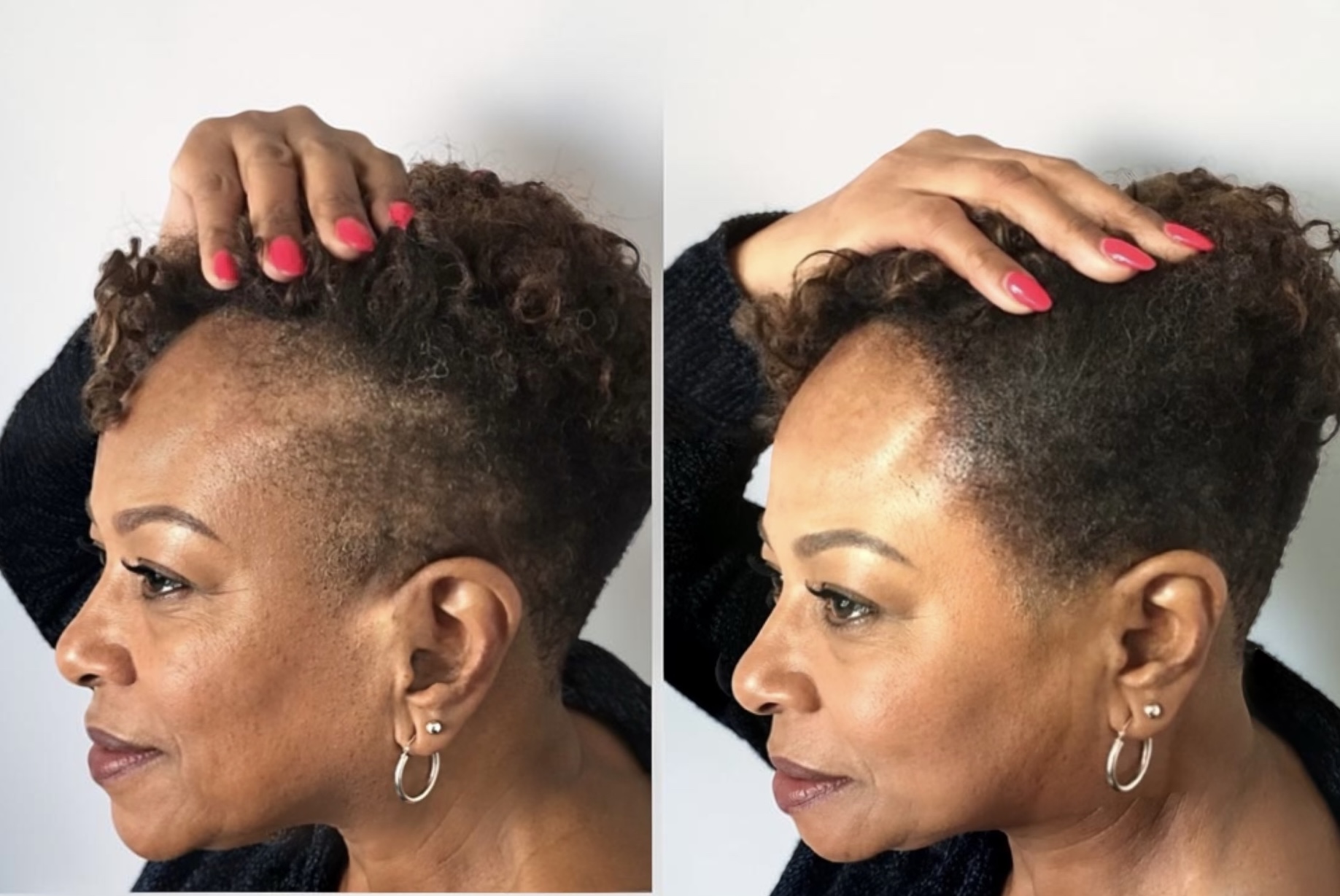Traction Alopecia