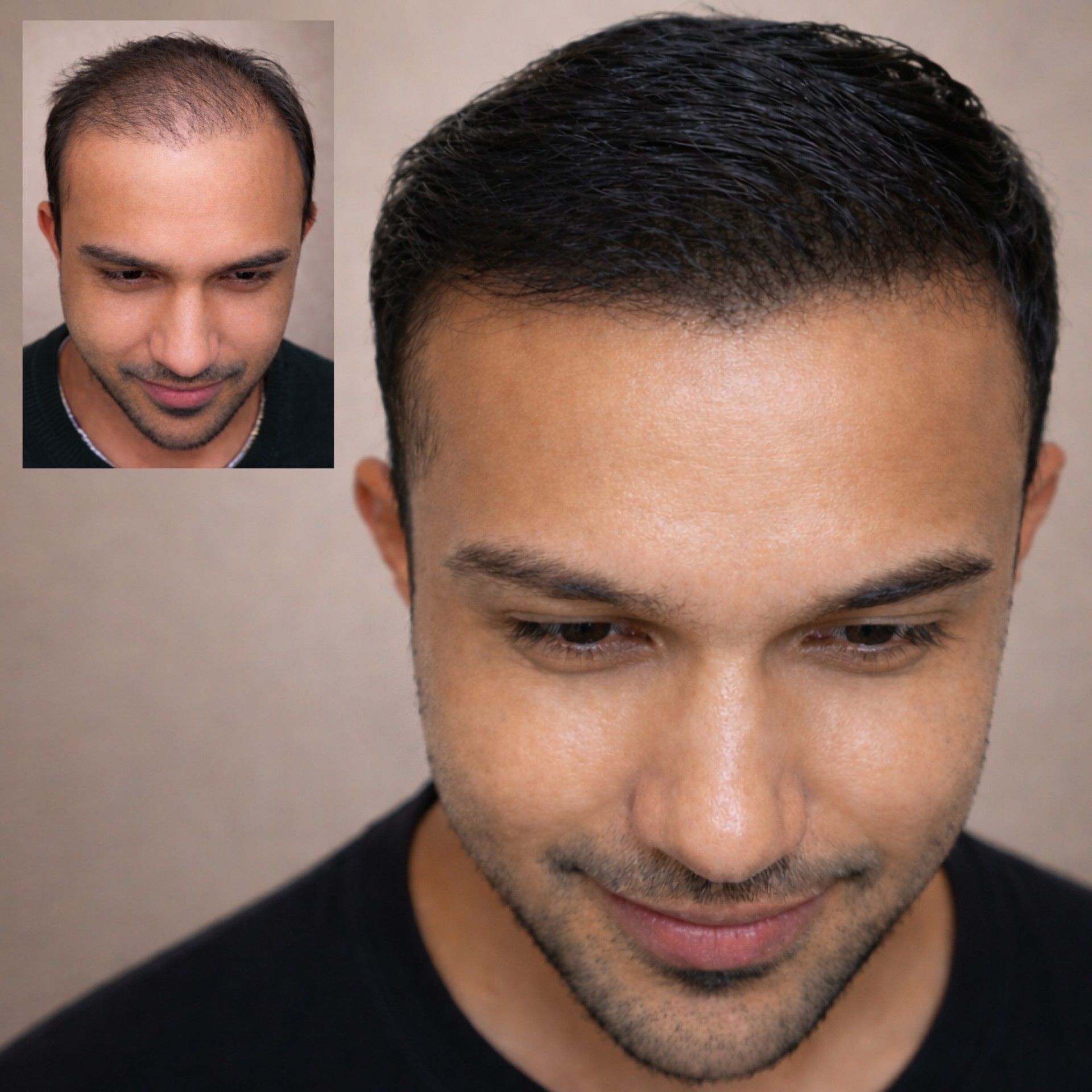 Scalpworx before and after result
