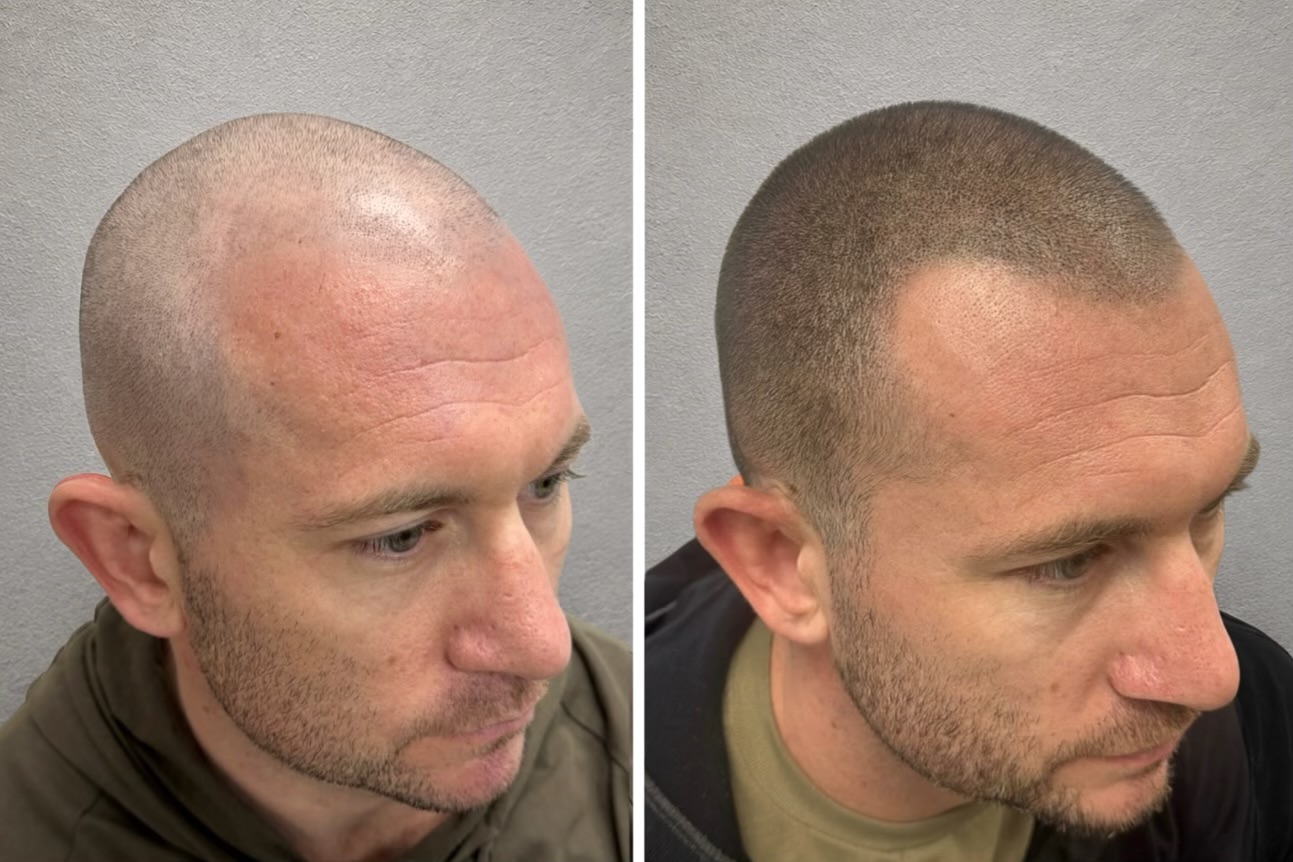 Male-Pattern Hair Loss