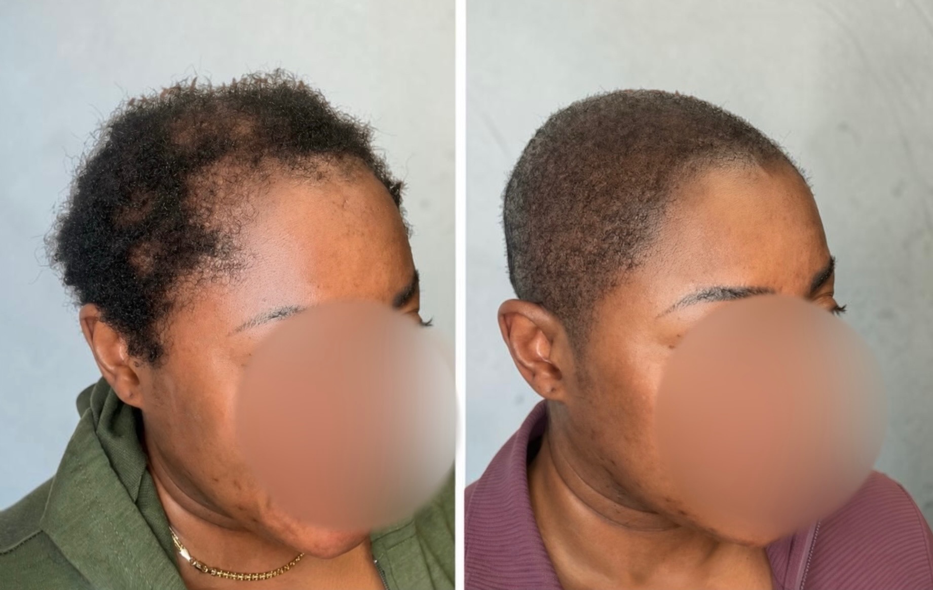 Alopecia Areata