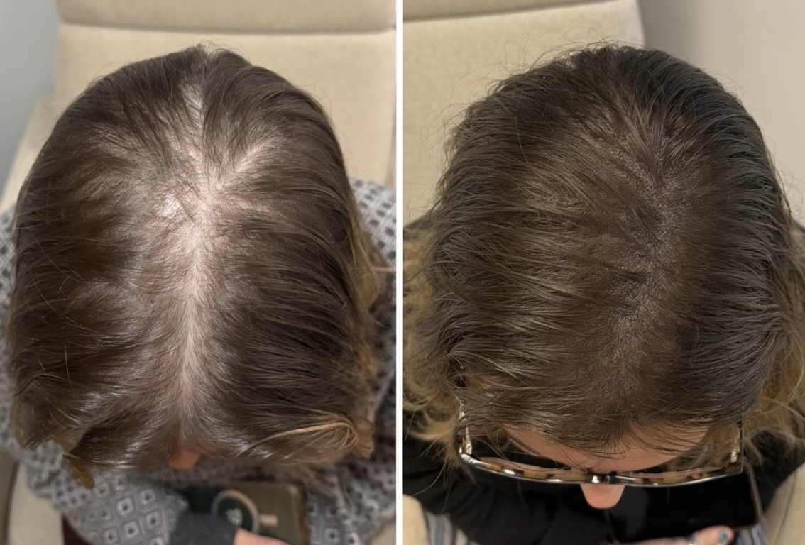 Female-Pattern Hair Loss